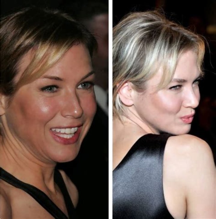 
Did Renee Zellweger Get Her Lips And Nose Done? Plastic Surgery Before And After Photos 