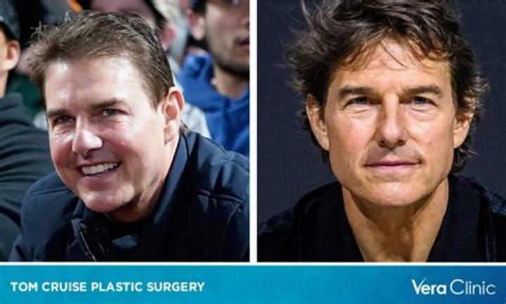 Has Tom Cruise Had Plastic Surgery? Here’s How His Puffy Face Got Fixed